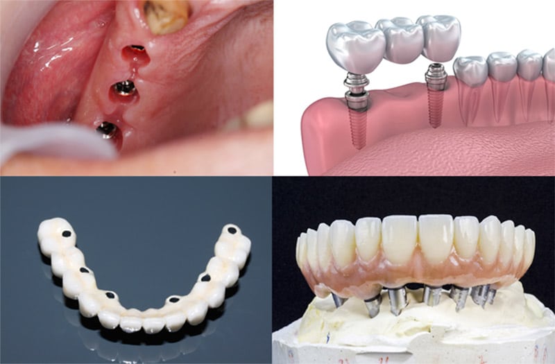 dentadura faltan piezas