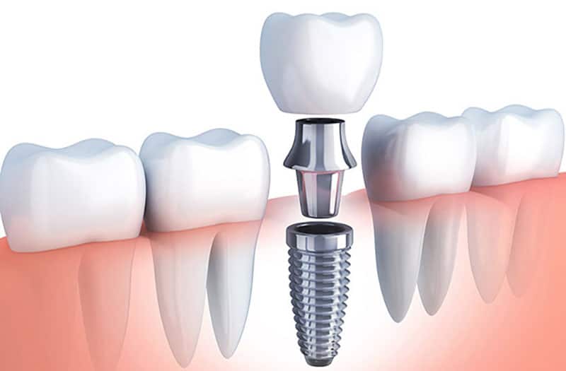 implante-dental implante dental