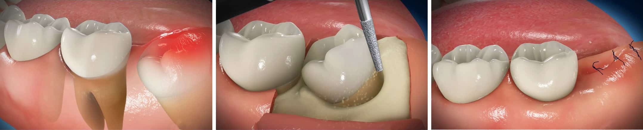 extraccion tercer molar