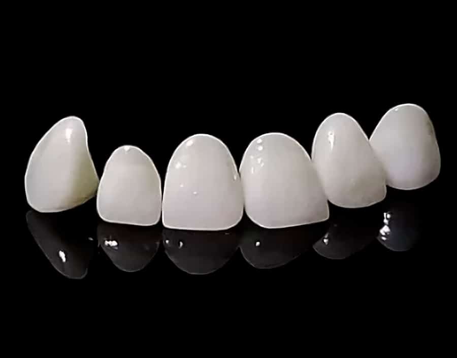 carillas porcelana