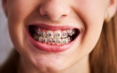 Brackets dentales en Donostia