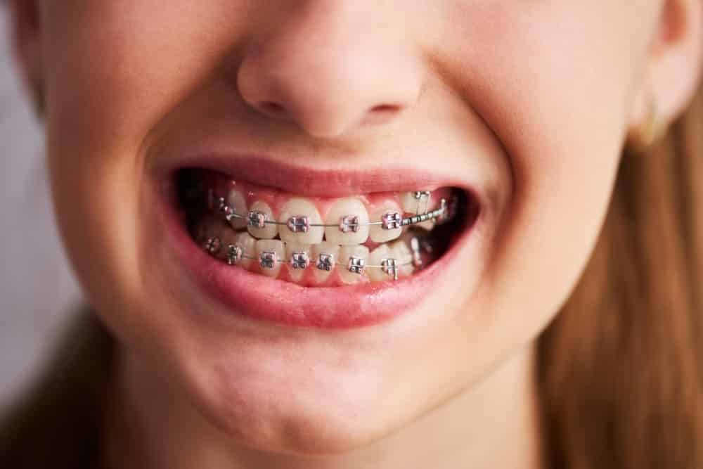 Brackets Donostia Brackets Donostia