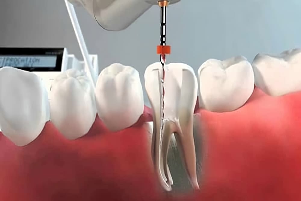 Reendodoncia Donostia Reendodoncia Donostia