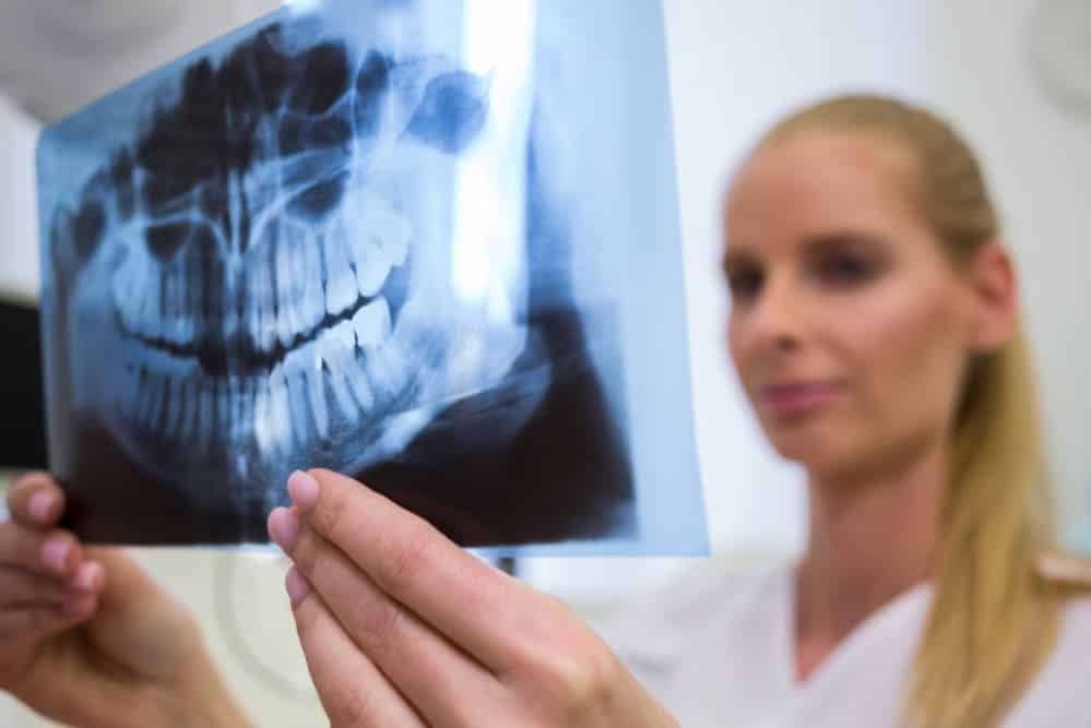 Injerto de hueso dental Donostia Injerto de hueso dental Donostia