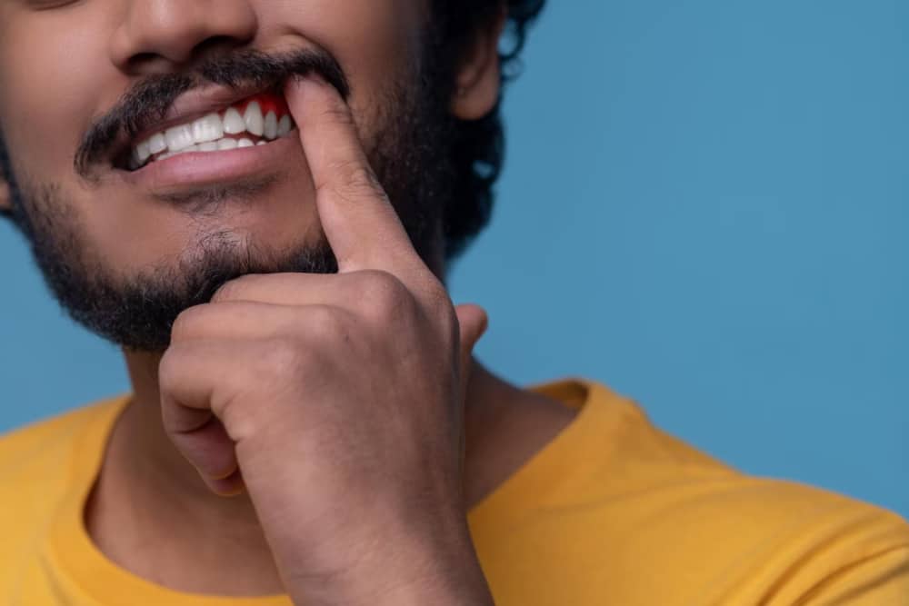 Gingivitis: qué es, síntomas y tratamiento