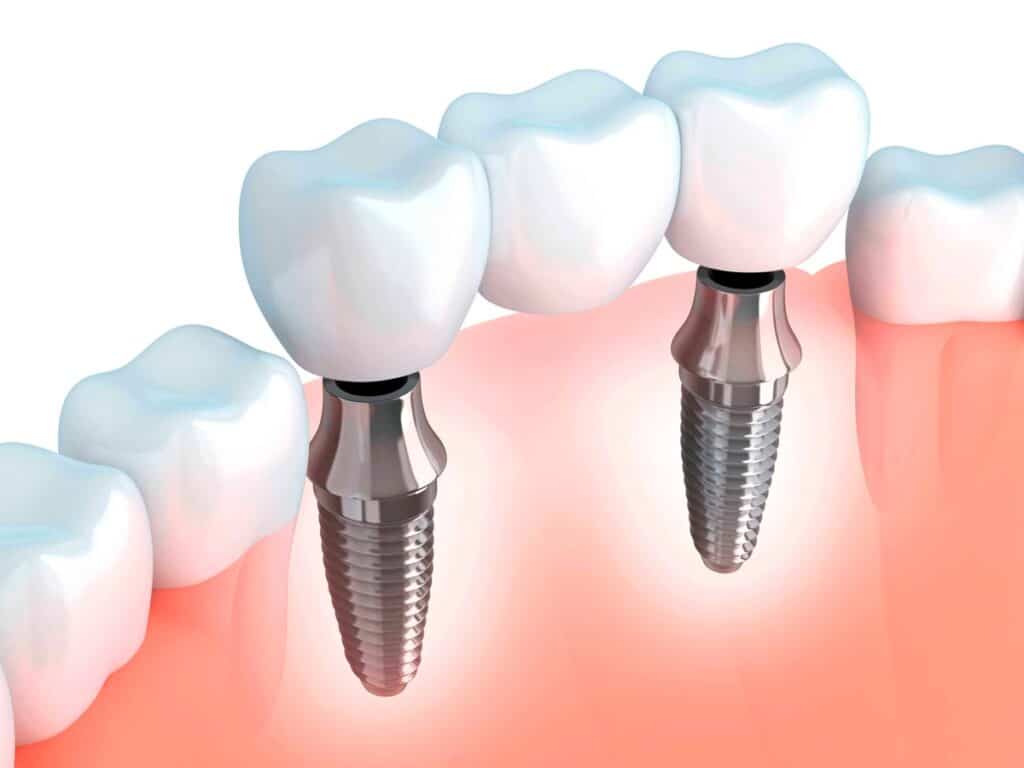 dibujo de implante dental