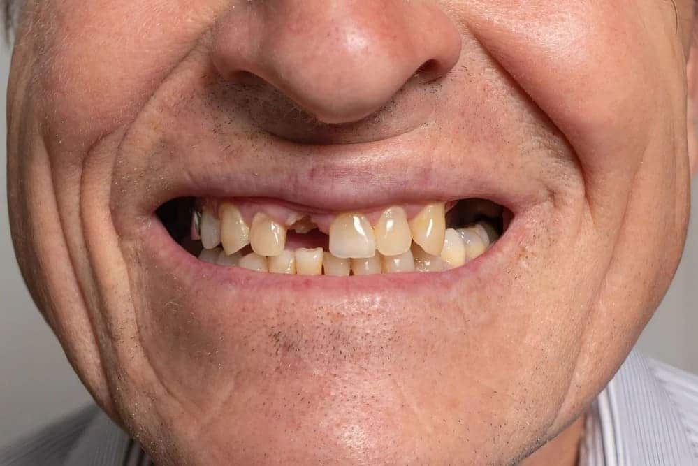 Causas y consecuencias de la pérdida de piezas dentales