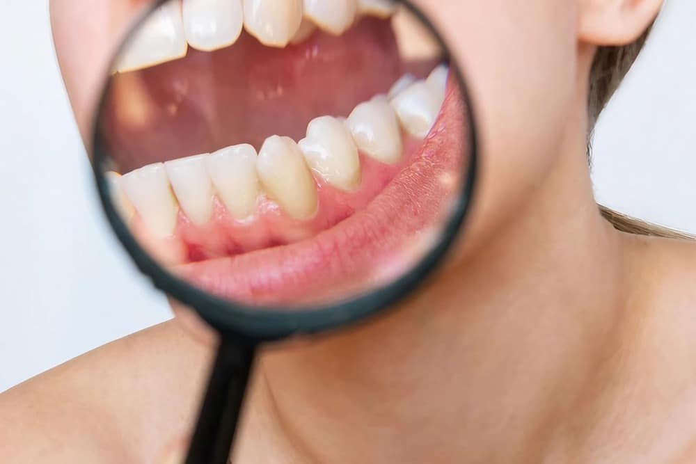 persona padeciendo abrasión dental persona padeciendo abrasión dental