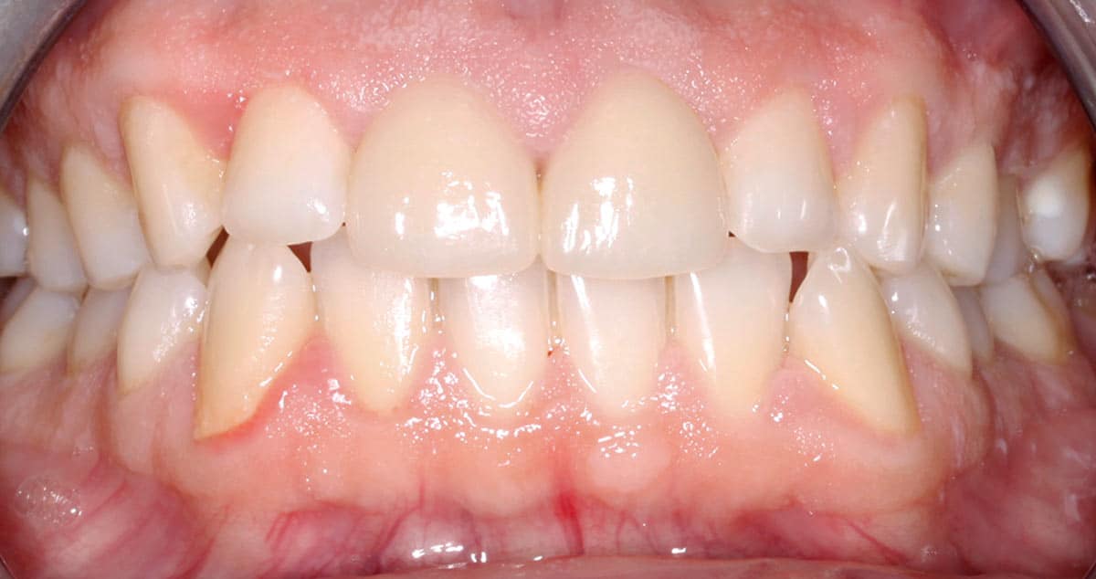 Caso 5, después del tratamiento de estética dental: huecos cerrados y color homogéneo