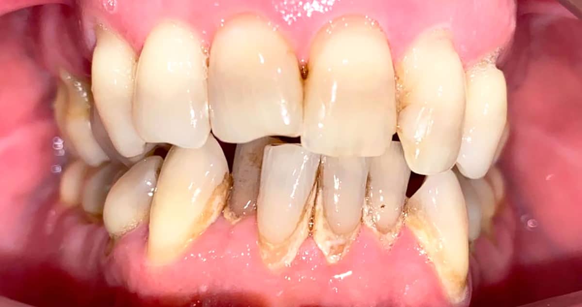 Antes Caso 20, antes: dientes apiñados y girados en ambas arcadas