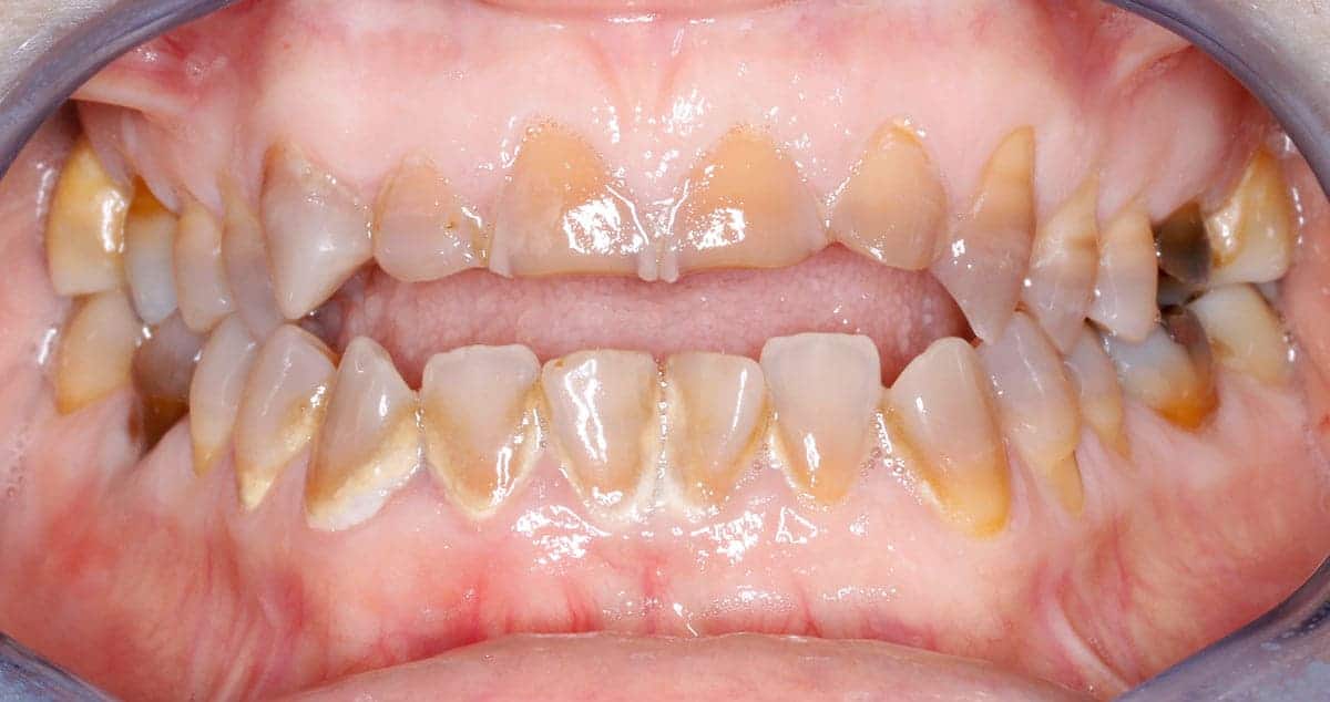 Antes Caso 1, antes: dientes superiores e inferiores desgastados y oscurecidos, con los bordes irregulares