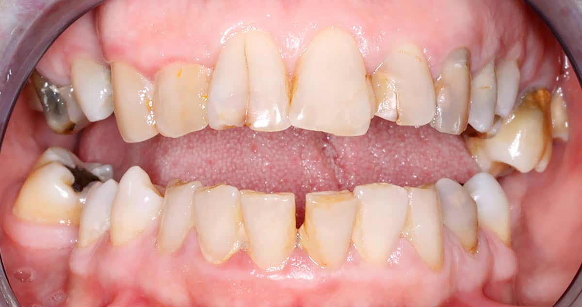 Antes Caso 3, antes: coronas antiguas con márgenes oscuros en la arcada superior