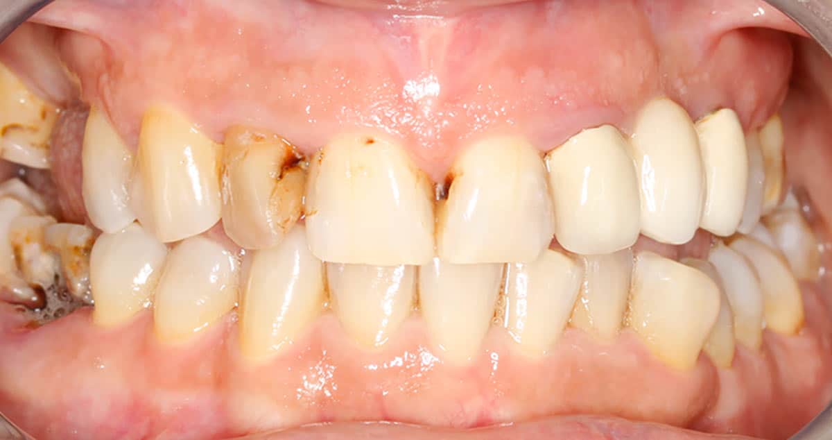 Antes Caso 4, antes: arcada superior con dientes amarillentos y bordes desiguales