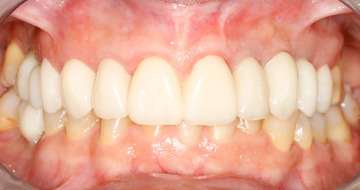 Caso 4, después del tratamiento con implantes: arcada superior completa y de tono uniforme