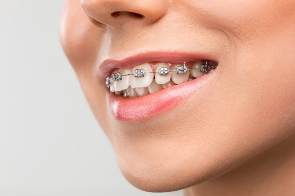 mujer joven con aparatos dentales mujer joven con aparatos dentales