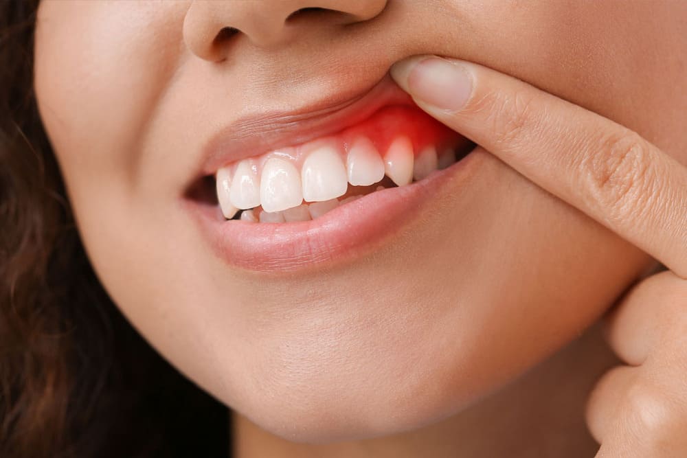 mujer ensenando su enfermedad gingival mujer ensenando su enfermedad gingival