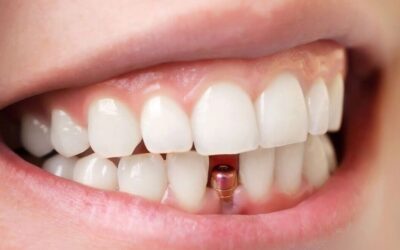 Prótesis dentales fijas en Donostia