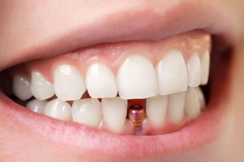 paciente con protesis dental fija tornillo