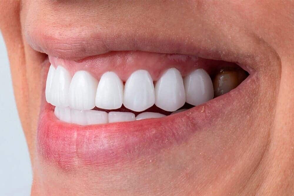 Carillas dentales de porcelana mínimamente invasivas
