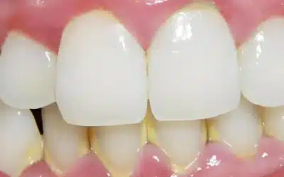 Placa dental: Qué debes saber