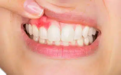 Gingivis: todo lo que necesitas saber
