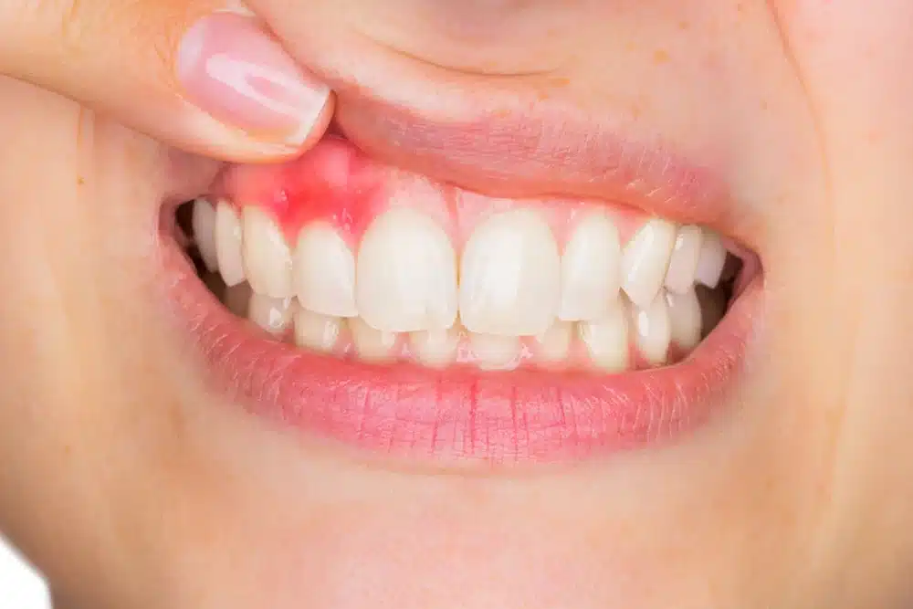 mujer ensenando boca con gingivitis