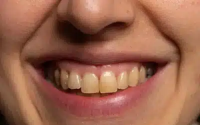 ¿Por qué tengo los Dientes amarillos?