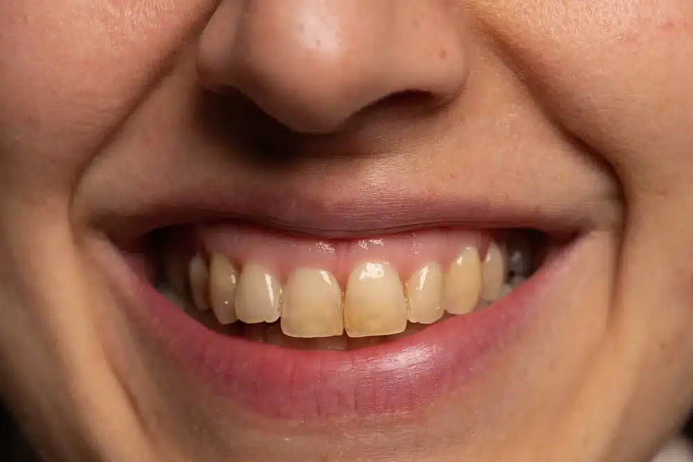 ¿Por qué tengo los Dientes amarillos?