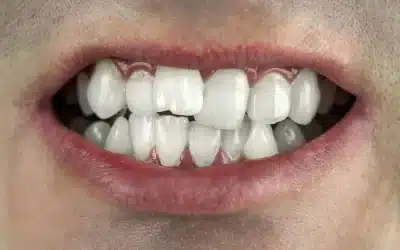 Dientes torcidos o apiñados: ¿Qué hacer?