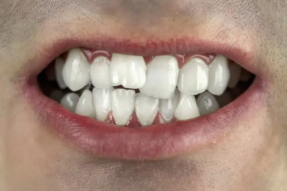 Dientes torcidos o apiñados: ¿Qué hacer?