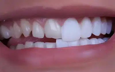 Carillas de composite inyectado: en qué consisten