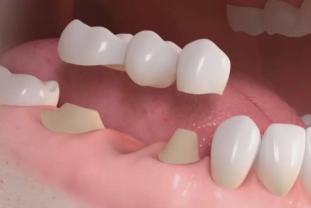 Puentes fijos de porcelana: ¿Qué son y para que sirven?