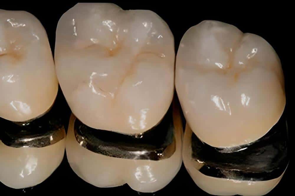 Puentes de metal-porcelana: ¿Qué es?