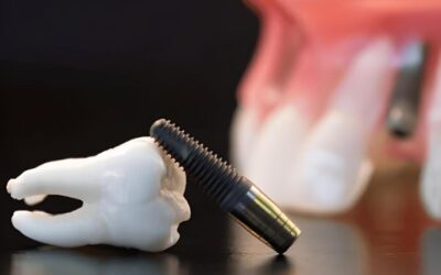 Implantes inmediatos post extracción: Guía completa