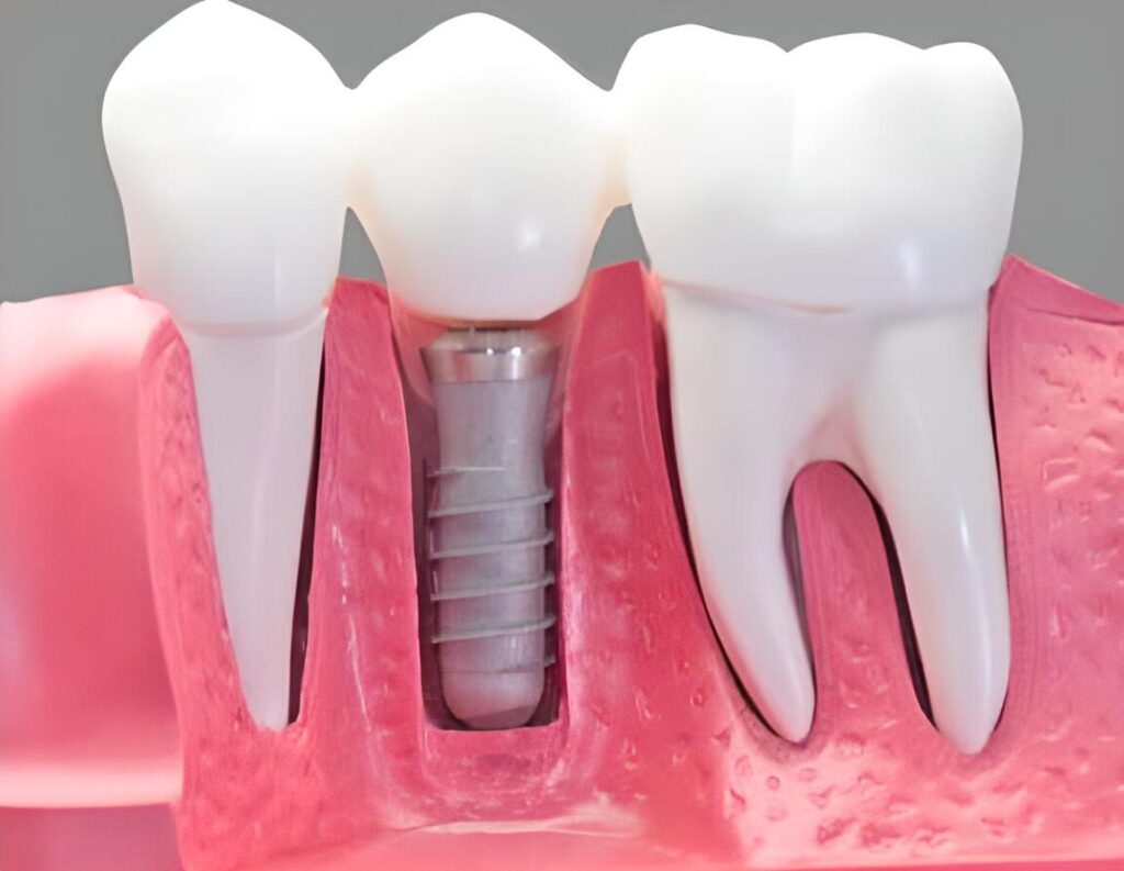 modelo 3d implante dental encia protesis