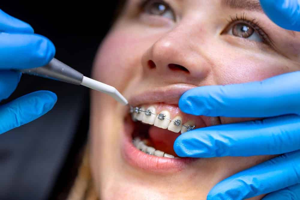detalle de boca de paciente con brackets recibiendo revision dental con guantes detalle de boca de paciente con brackets recibiendo revision dental con guantes