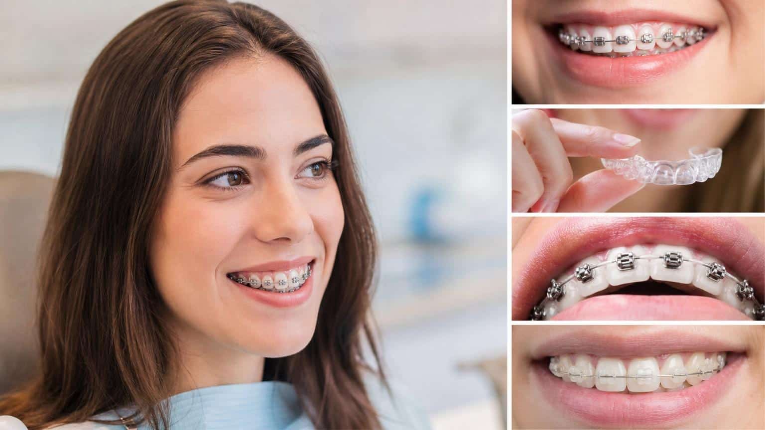 Collage of dental treatments featuring a woman with metal braces and close-ups of clear aligners, lingual braces, and ceramic braces. Collage of dental treatments featuring a woman with metal braces and close-ups of clear aligners, lingual braces, and ceramic braces.