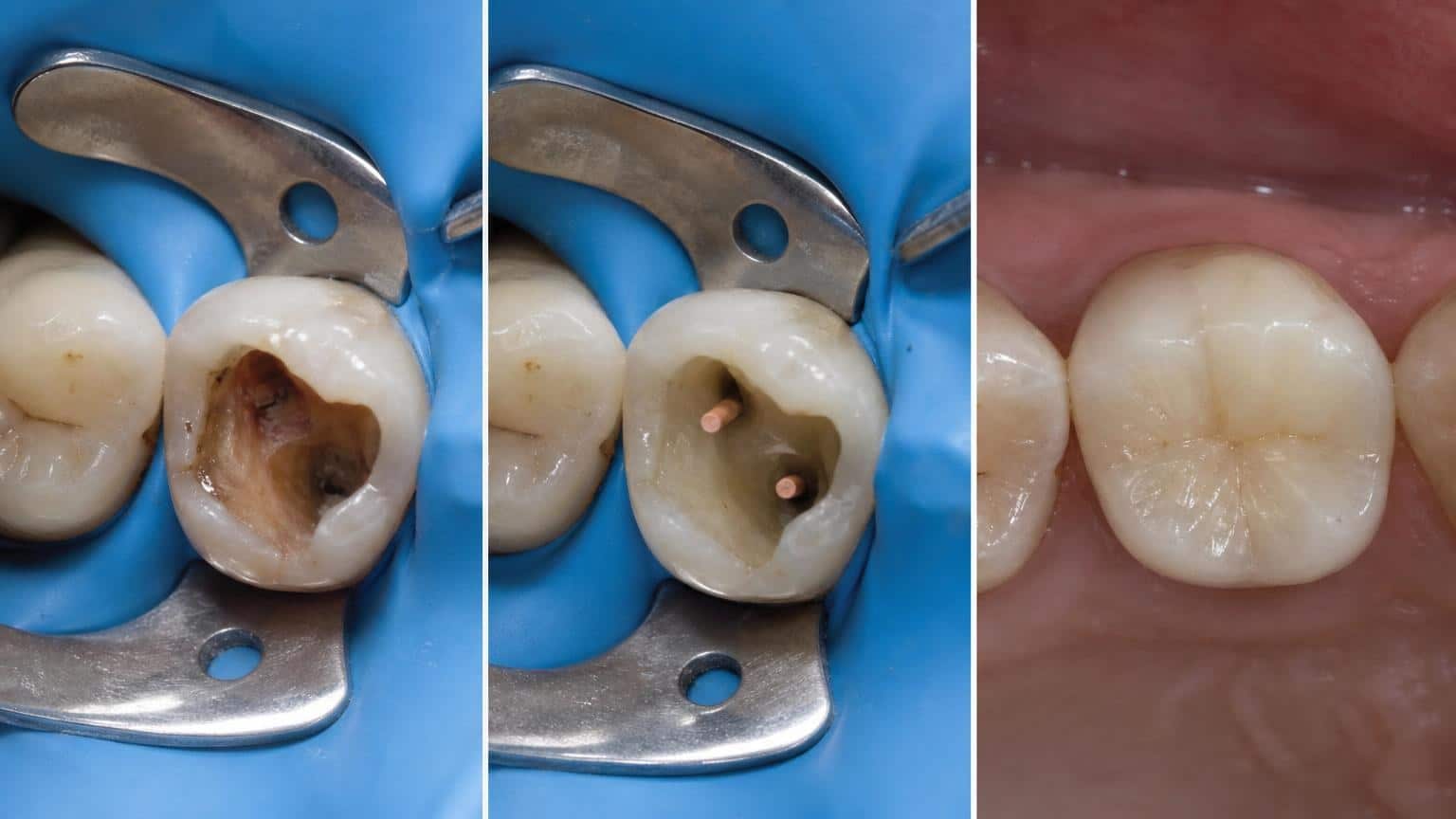 Three-panel sequence showing a decayed molar, the root canal filling process with gutta-percha points, and the final restored tooth. Three-panel sequence showing a decayed molar, the root canal filling process with gutta-percha points, and the final restored tooth.