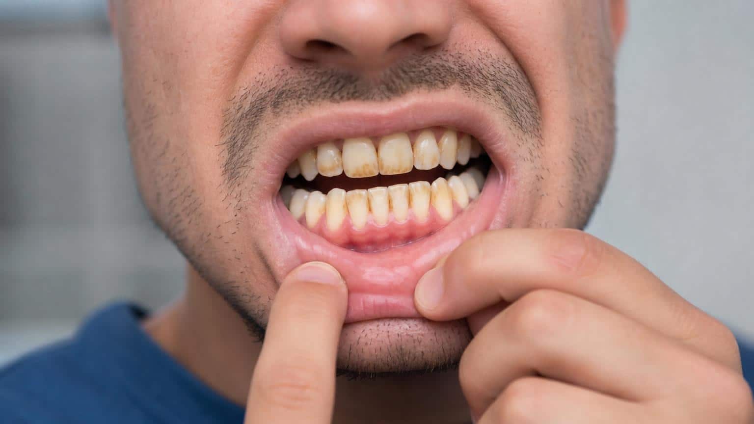 Close-up of a person pulling down their lower lip to reveal yellowed teeth with prominent brown stains and plaque buildup. Close-up of a person pulling down their lower lip to reveal yellowed teeth with prominent brown stains and plaque buildup.